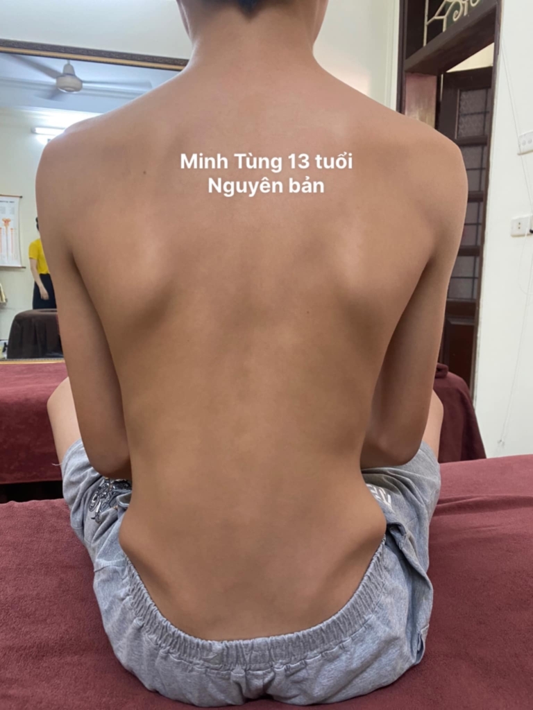cong vẹo cột sống ở trẻ em