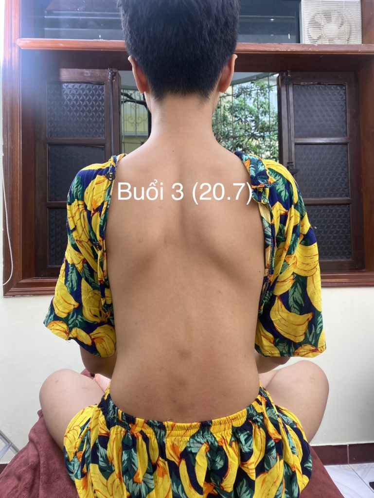 Cong vẹo cột sống ở trẻ em