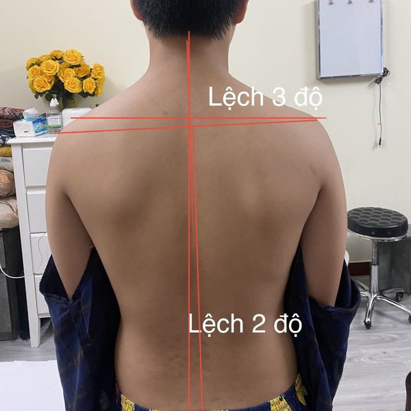 Cong vẹo cột sống ở trẻ em